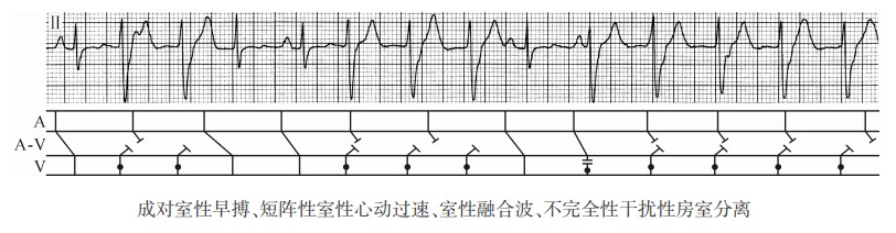 成对室性早搏、短阵性室性心动过速、室性融合波、不完全性干扰性房室分离（心电图）