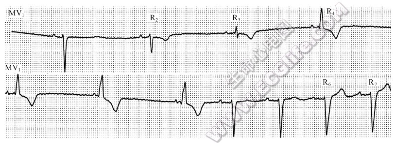 干扰性心室分离（心电图）