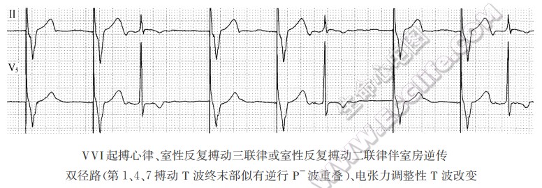 心室起搏（VVI心脏起搏器）的心电图特征