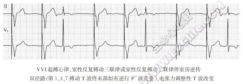 VVI起搏心律、室性反复搏动三联律或室性反复搏动二联律伴室房逆传双径路、电张力调整性T波改变