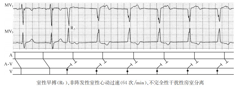 室性早搏(R3)、非阵发性室性心动过速(64次/min)、不完全性干扰性房室分离（心电图）
