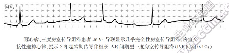 冠心病、三度房室传导阻滞患者，MⅦ导联显示几乎完全性房室传导阻滞、房室交接陛逸搏心律、提示2相超常期传导伴极长PR间期型一度房室传导阻滞(PR间期0.92s)
（心电图）