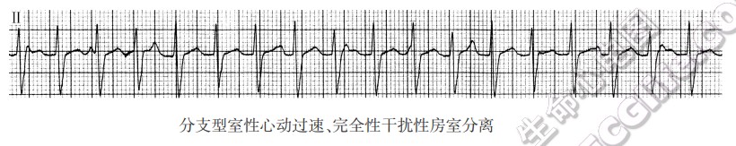 分支型室性心动过速、完全性干扰性房室分离（心电图）