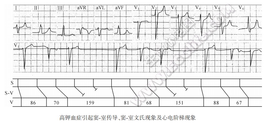 高钾血症弓I起窦室传导、窦室文氏现象及心电阶梯现象心电图精解