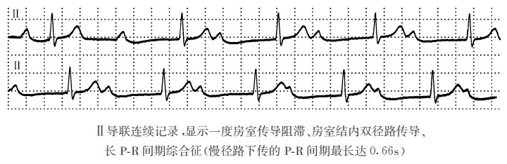 巨R波综合征心电图