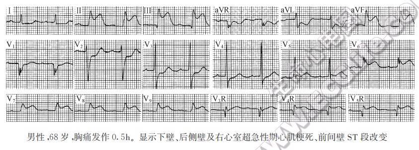 远离梗死区ST段改变的临床意义