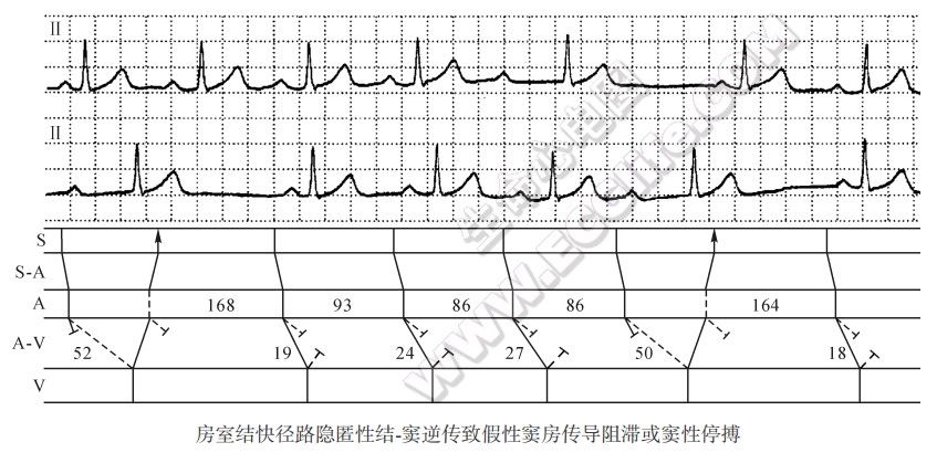 房室结快径路隐匿性结窦逆传致假性窦房传导阻滞或窦性停搏