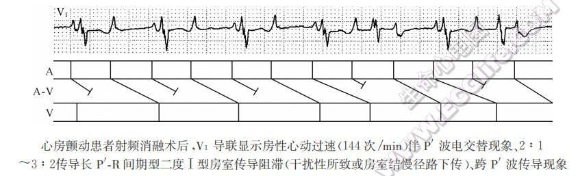 P波电交替现象2