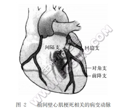 前间壁心肌梗死相关的病变动脉