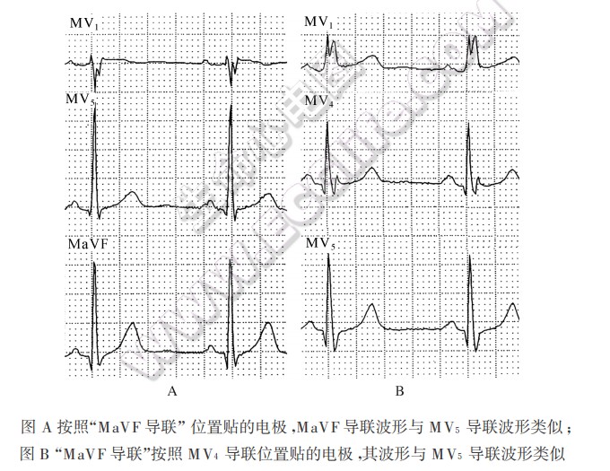 MaVF导联心电图