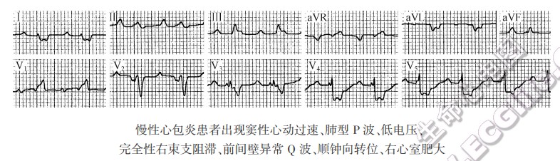 慢性心包炎心电图