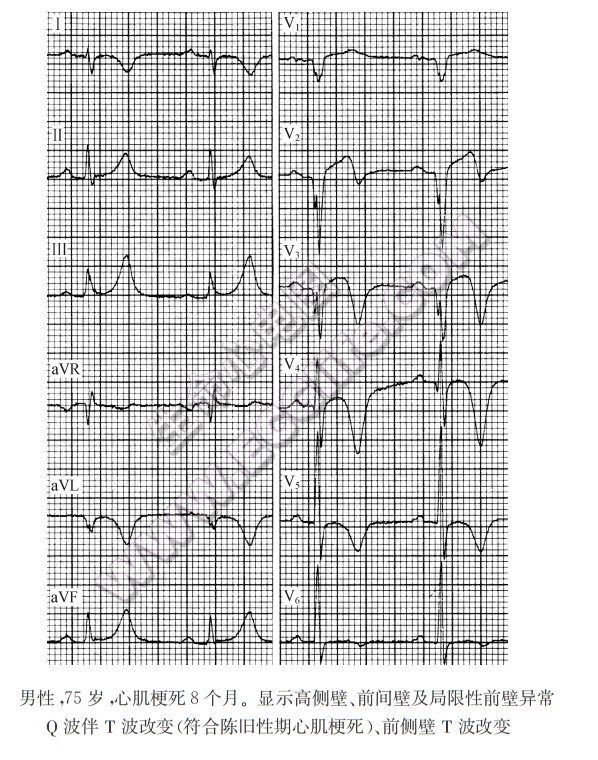 陈旧性期（慢性稳定期）心肌梗死心电图2
