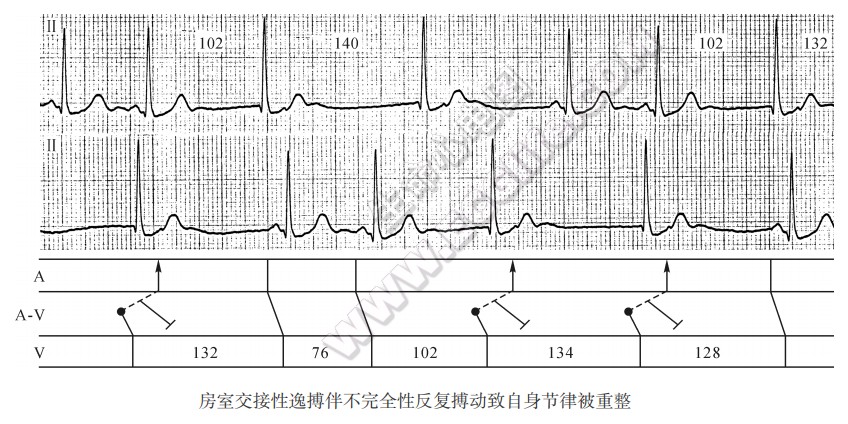 房室交接性逸搏伴不完全性反复搏动致自身节律被重整心电图精解