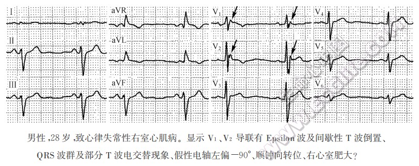 右室心肌病心电图2