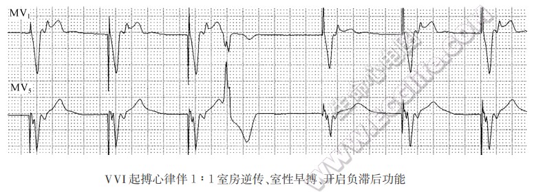 VVI心脏起搏心律伴1：1室房逆传、室性早搏、开启负滞后功能心电图