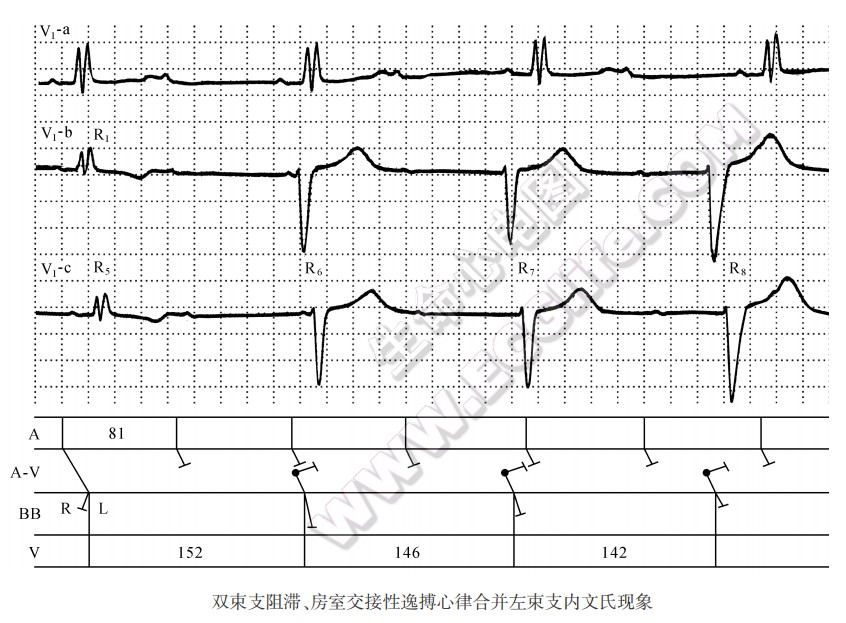 双束支阻滞、房室交接性逸搏心律合并左束支内文氏现象