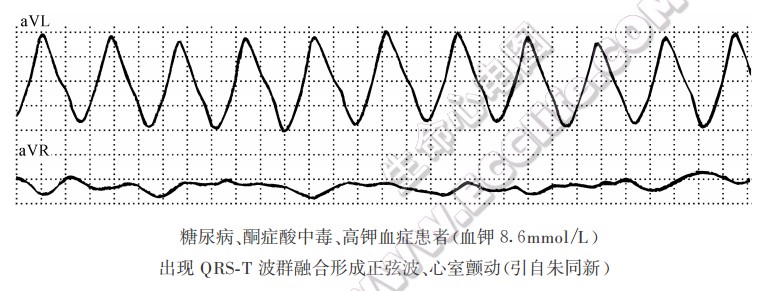 糖尿病、酮症酸中毒、高钾血症患者，QRS-T波群融合形成正弦波心电图