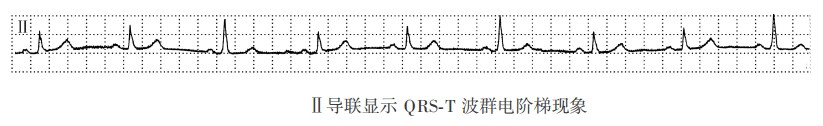 Ⅱ导联显示QRS-T波群电阶梯现象