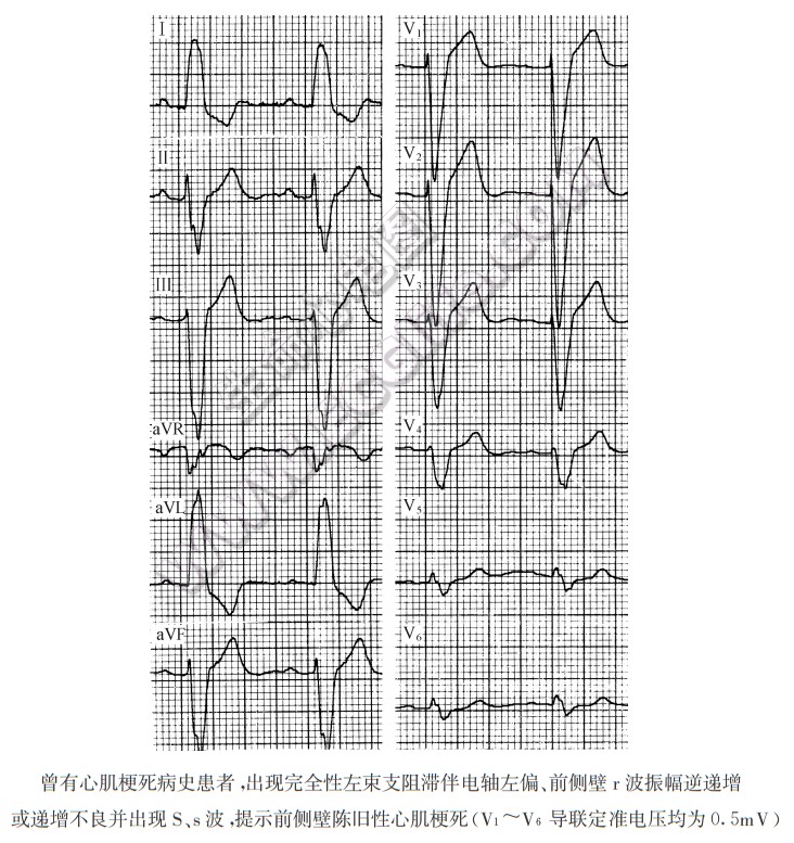 心肌梗死合并左束支阻滞心电图