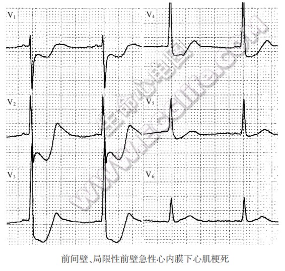 心内膜下心肌梗死的心电图表现