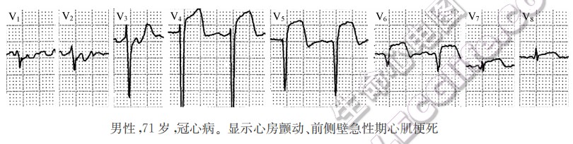 急性期心肌梗死心电图