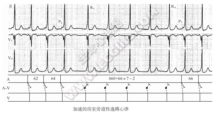 加速的房室旁道性逸博心律心电图精解