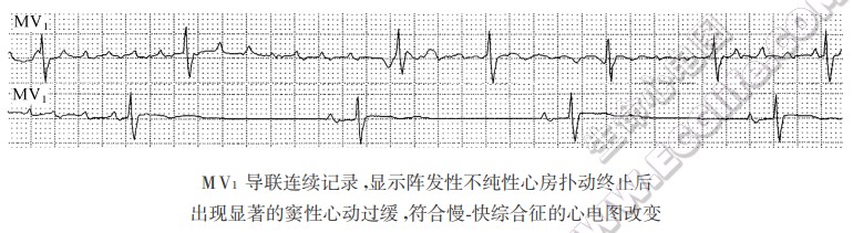 心脏慢快综合征