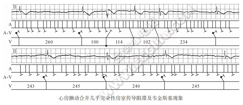 心房颤动合并几乎完全性房室传导阻滞及韦金斯基现象心电图