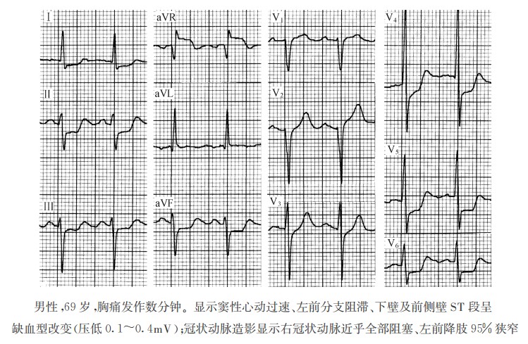 冠心病的病理及心电图表现