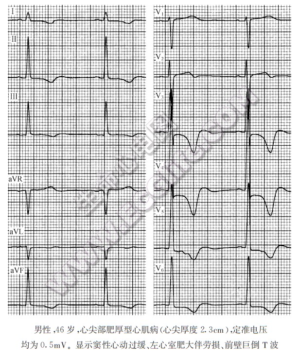 肥厚型心肌病的病理及心电图表现