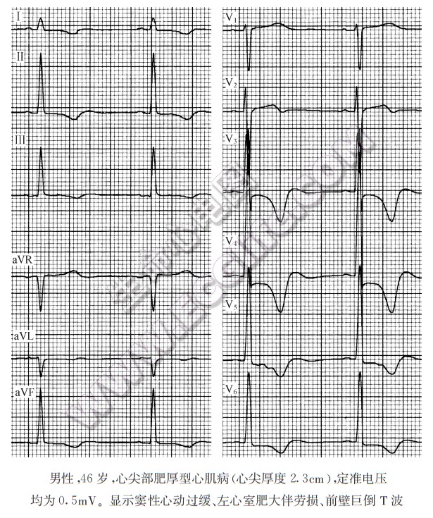 肥厚型心肌病心电图表现