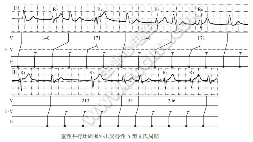 室性并行灶周围外出交替性A型文氏周期心电图精解