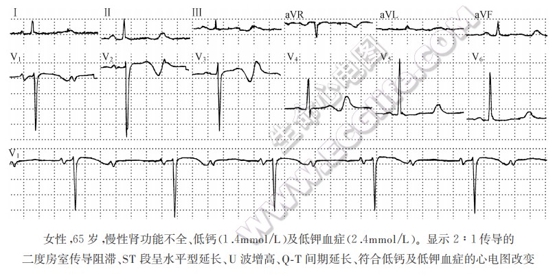 低钙及低钾血症的心电图改变