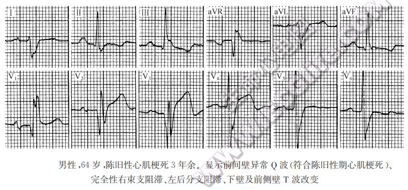 陈旧性期（慢性稳定期）心肌梗死心电图1
