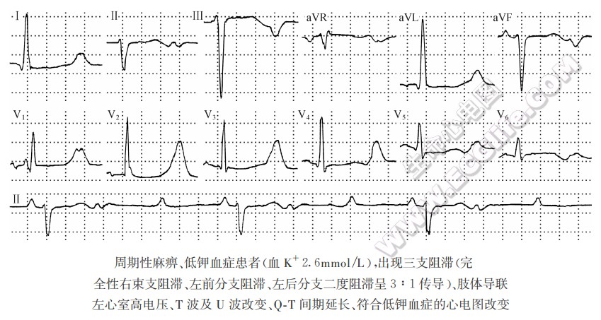 低钾血症的心电图改变
