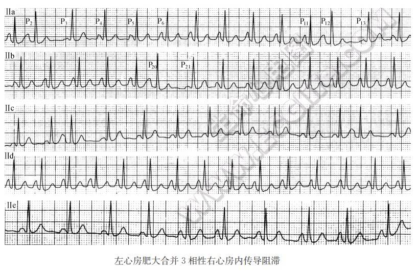 左心房肥大合并3相性右心房内传导阻滞心电图精解