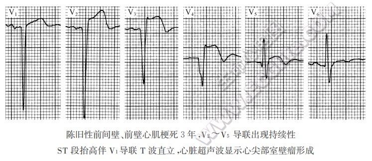 心肌梗死并发症的心电图改变