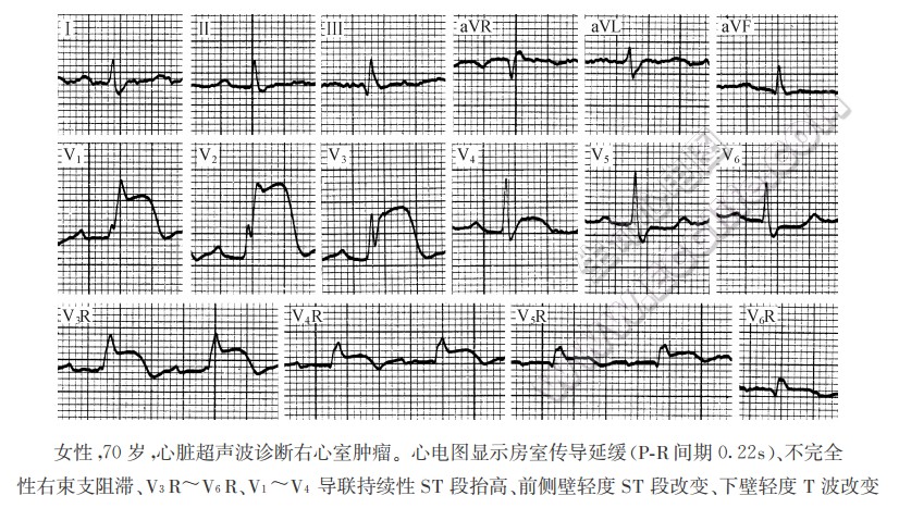 右心室心肌梗死的临床心电图表现