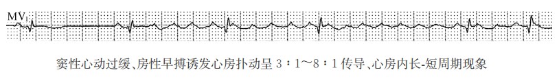 窦性心动过缓、房性早搏诱发心房扑动呈3：1～8：1传导、心房内长短周期现象心电图