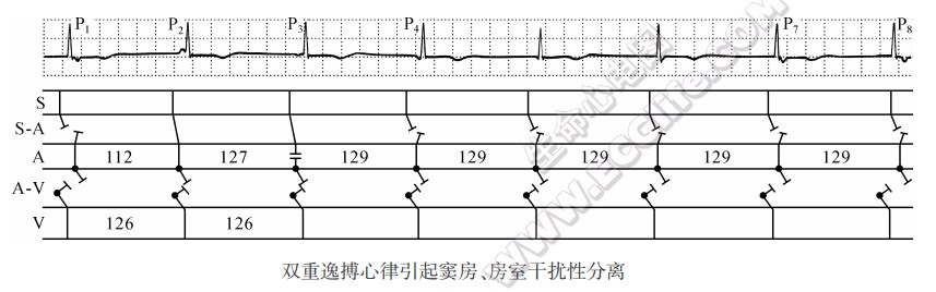 双重逸搏心律引起窦房、房室干扰性分离心电图