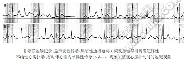 Ⅱ导联连续记录湿示窦性搏动（属窦性逸搏范畴）、频发房性早搏污发短阵性不纯性心房扑动，有时伴心室内差异性传导(Ashman现象)、呈现心房扑动时的连缀现象心电图