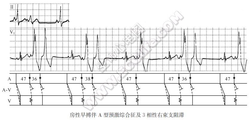 房性早搏伴A型预激综合征及3相性右束支阻滞心电图精解