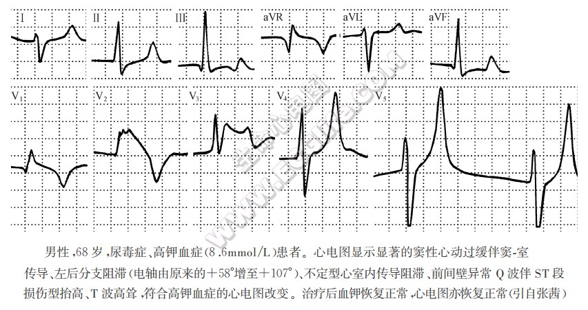 高钾血症心电图