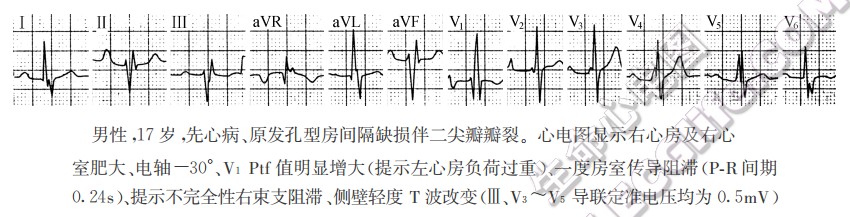 原发孔缺损型的心电图特征