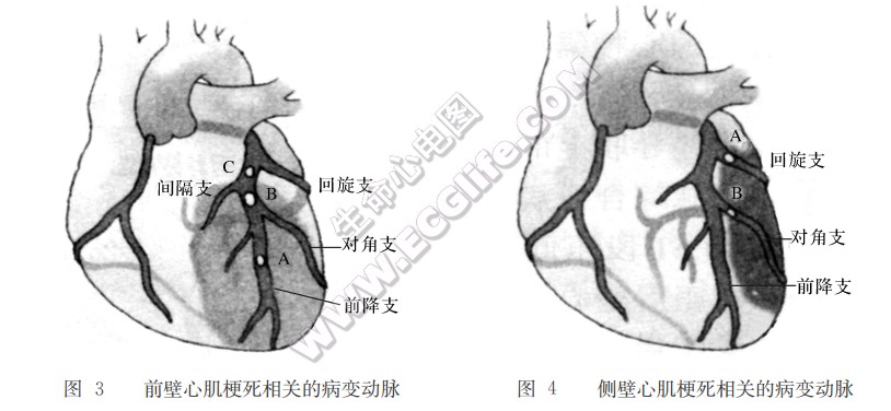 前壁心肌梗死相关的病变动脉、侧壁心肌梗死相关的病变动脉