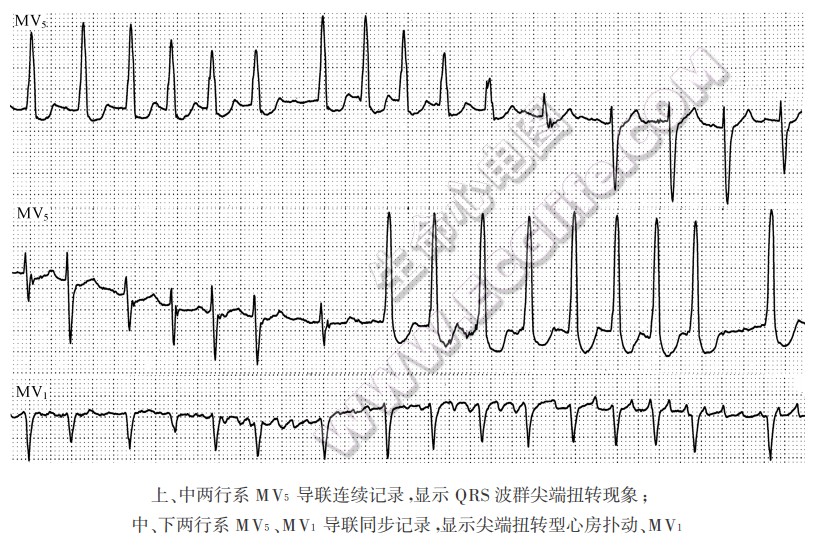 尖端扭转型心房扑动或颤动伴QRS波群尖端扭转现象