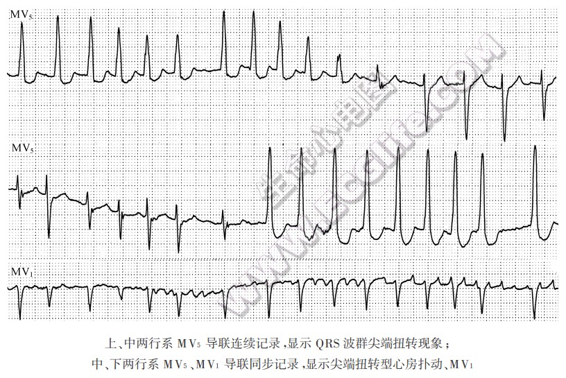 尖端扭转型心房扑动或心房颤动伴QRS波群尖端扭转现象心电图