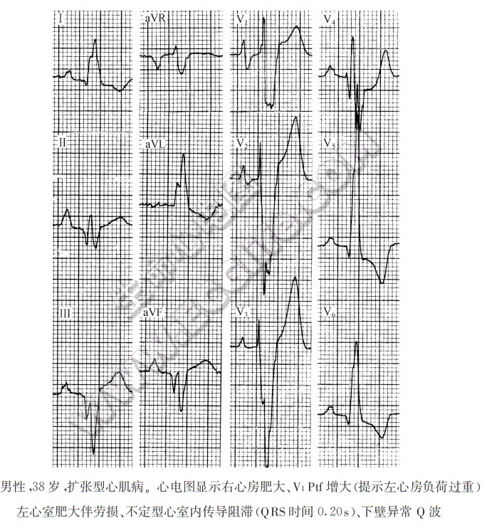 扩张型心肌病：病理及心电图表现