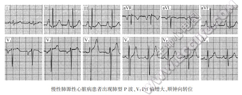 慢性肺源性心脏病患者出现肺型P波、V1Ptf值增大、顺钟向转位心电图