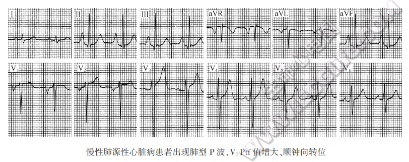 心脏顺钟向转位心电图图片